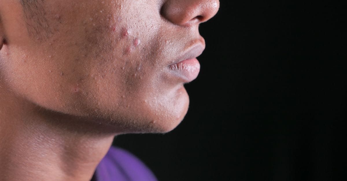 Side view close-up of a young man's face with visible acne on cheek and jawline.